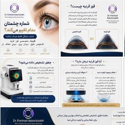علایم ، درمان و تشخیص قوز قرنیه